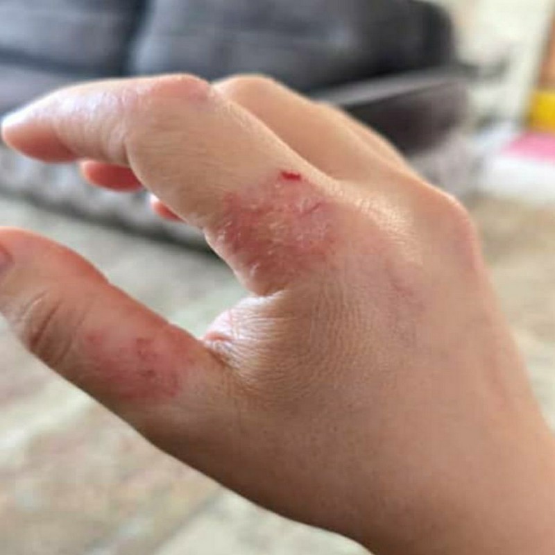 کرم درموویت Dermovate سبز اصل انگلیسی 30 گرمی